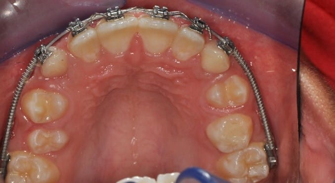 Interceptive orthodontic treatment is done to expand the patient’s jaw using braces and springs at Jasbir Dental Specialist Melaka.