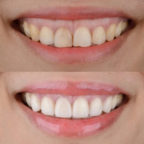 gummy smile