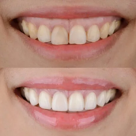 gummy smile