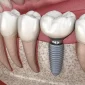 implant service graphic 85x85